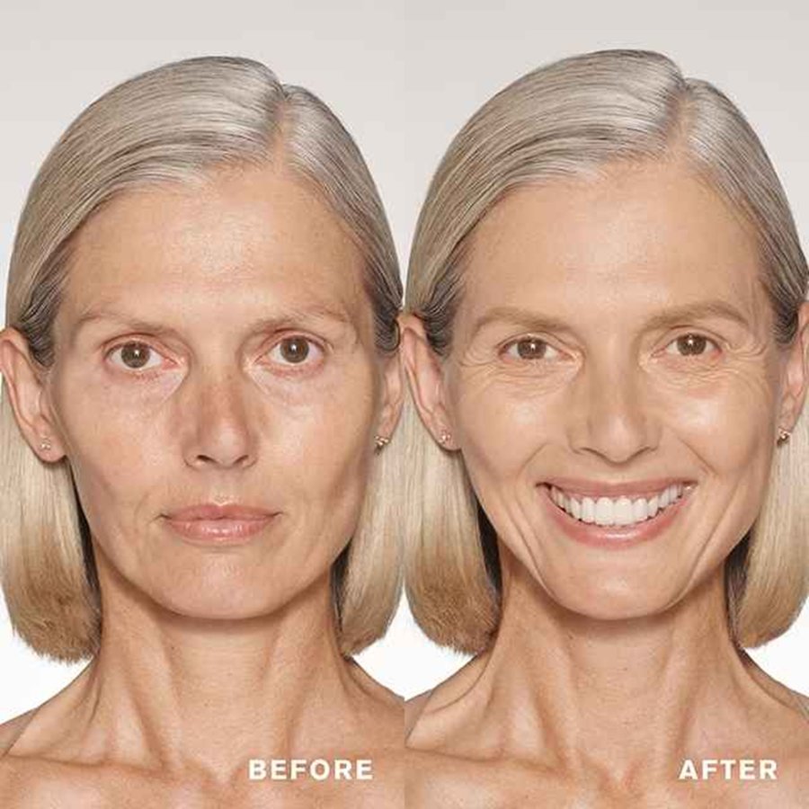 Before and after comparison of a woman's face with visible skin improvement.